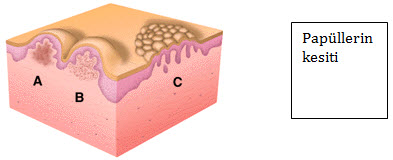 Akne Vulgaris